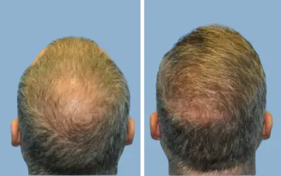 Before and After